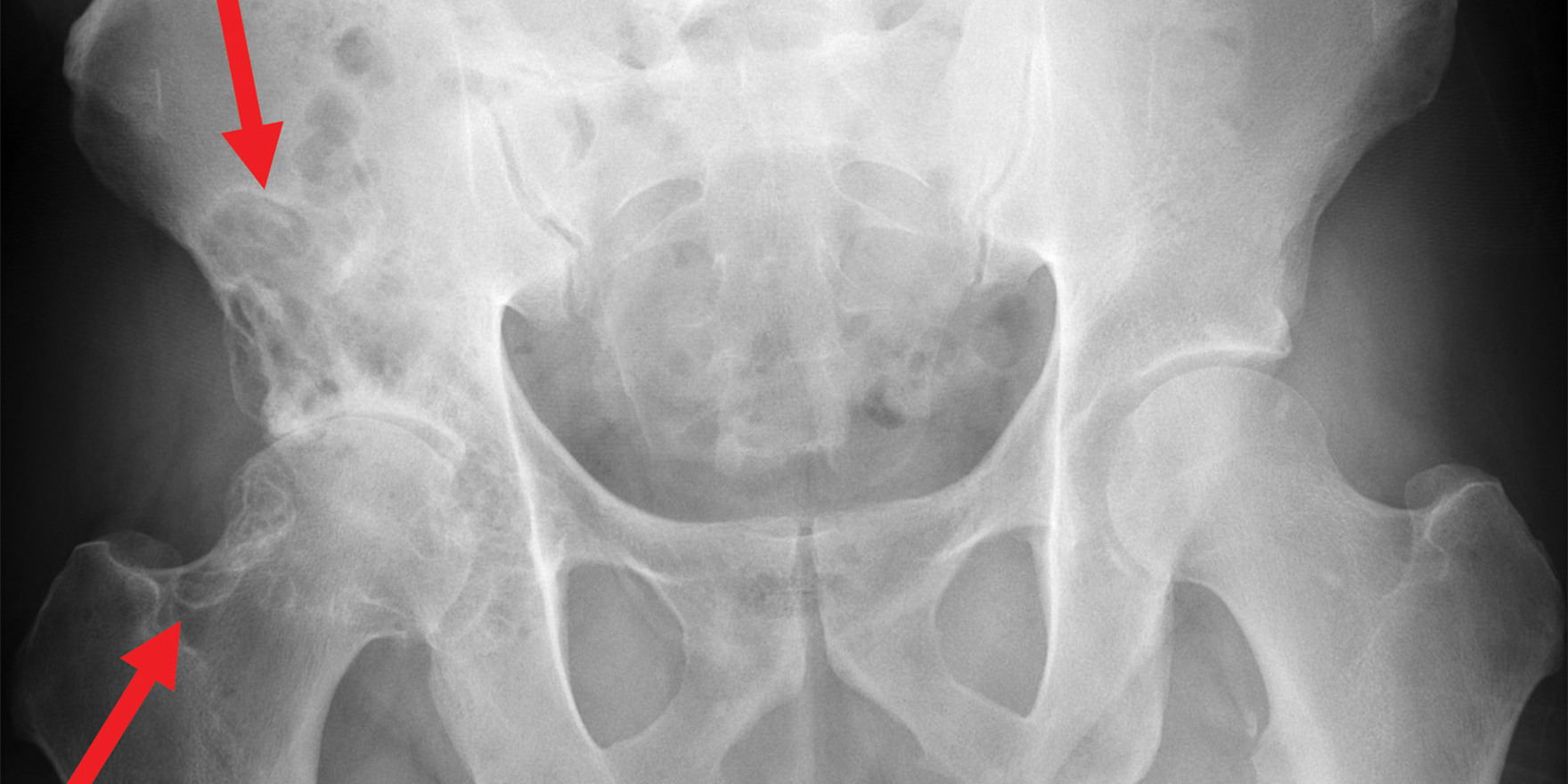 Case study: hip and anterior groin pain - Rheuma