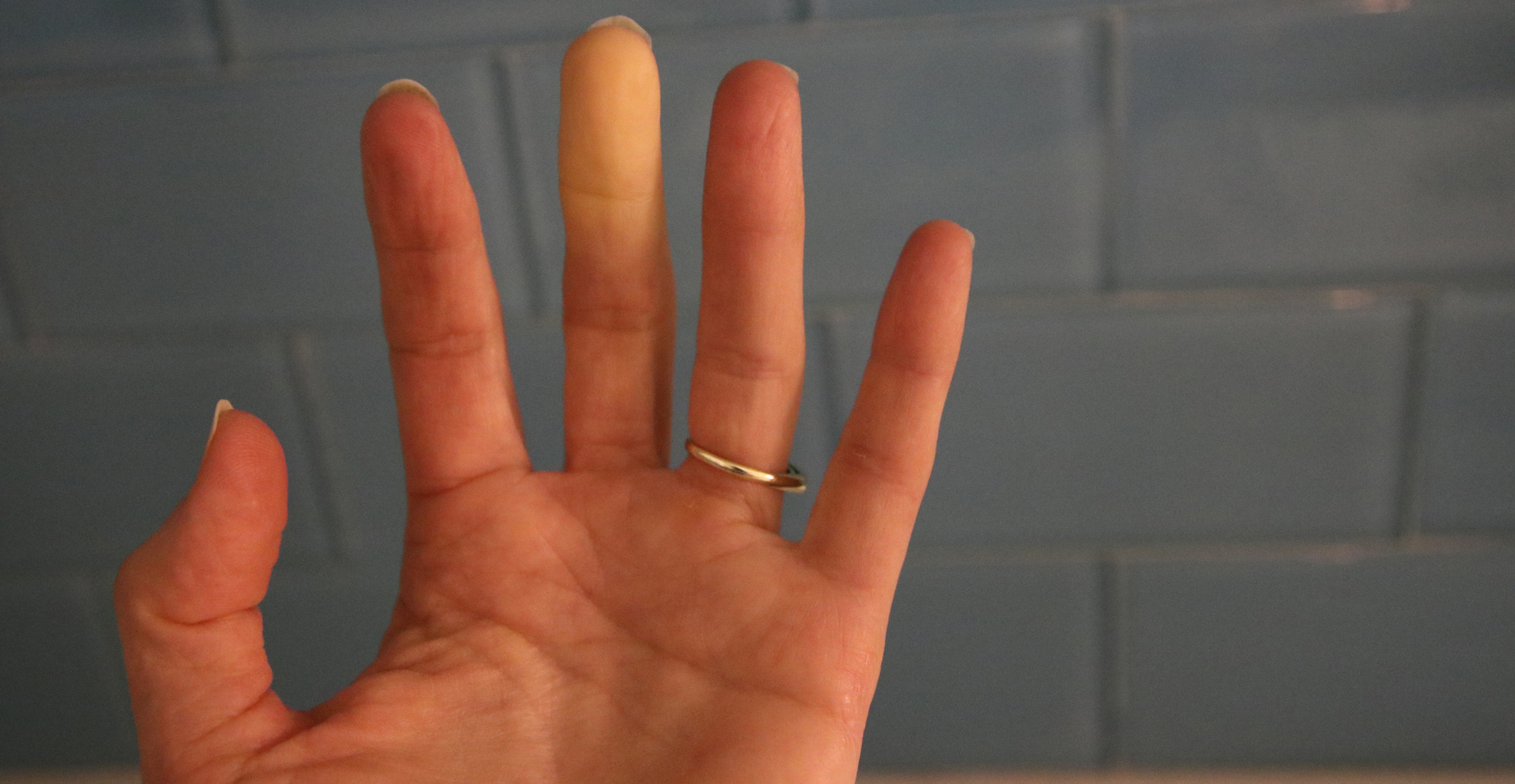 Finger Injury - No Pain but Swollen Knuckle and Restricted Range of Motion
