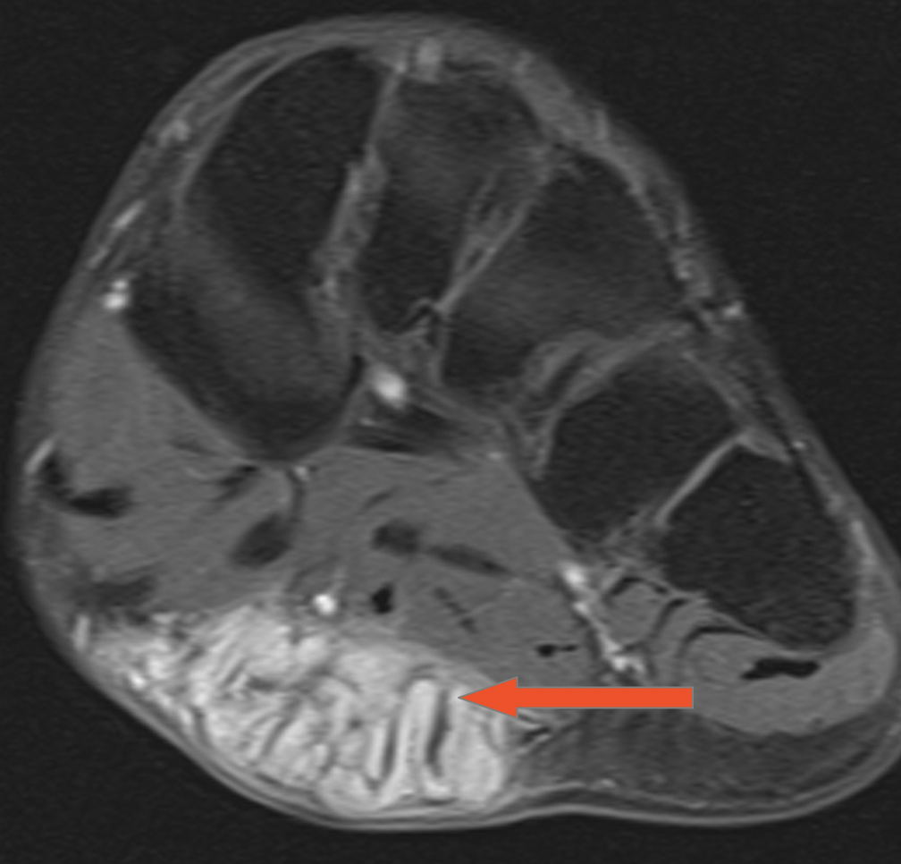 Proliferative Plantar Fibroma - A Case Study - Rheuma